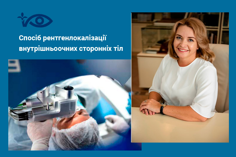 Спосіб рентгенлокалізації внутрішньоочних сторонніх тіл