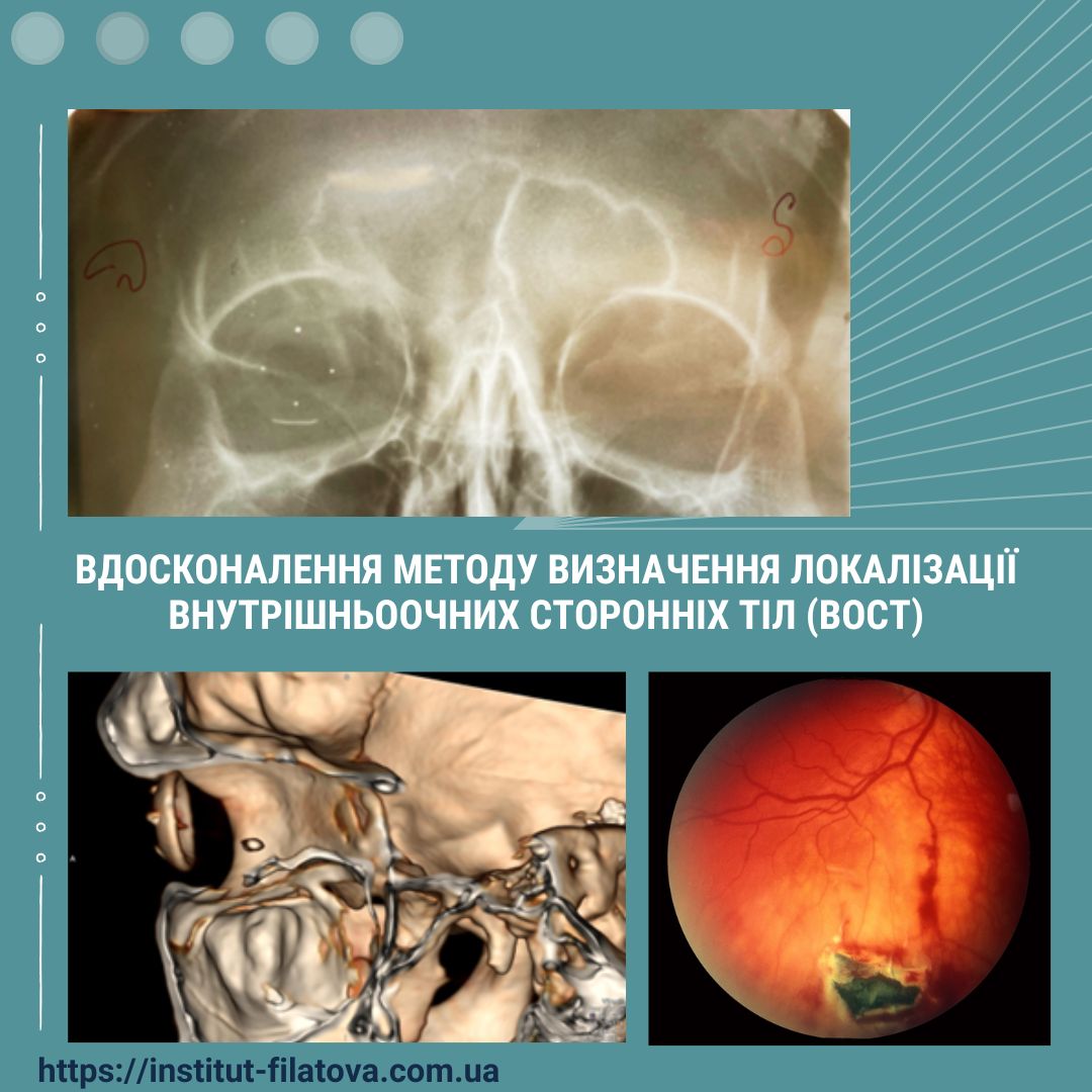 Вдосконалення методу визначення локалізації внутрішньоочних сторонніх тіл (ВОСТ) 