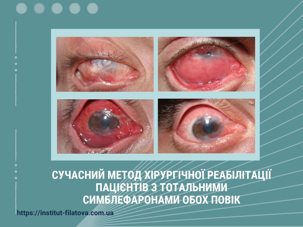 Сучасний метод хірургічної реабілітації пацієнтів з тотальними симблефаронами обох повік