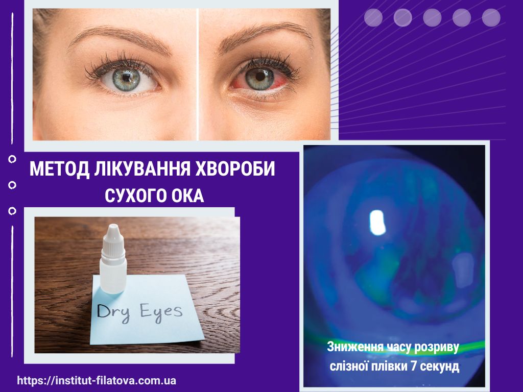 Огляд методів лікування хвороби сухого ока в амбулаторних умовах