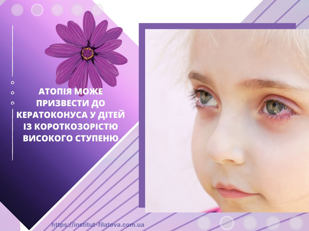 Атопія може призвести до кератоконуса у дітей із короткозорістю високого ступеню