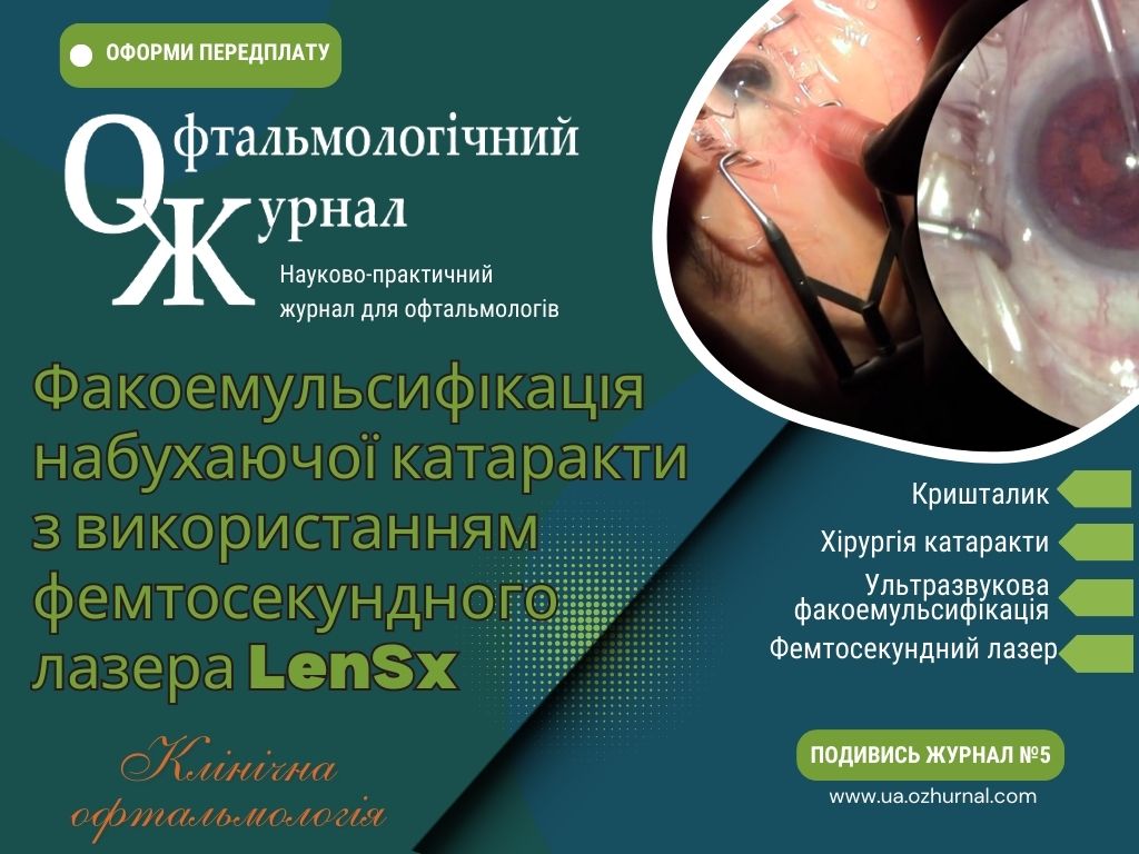 Факоемульсифікація набухаючої катаракти з використанням фемтосекундного лазера LENSX