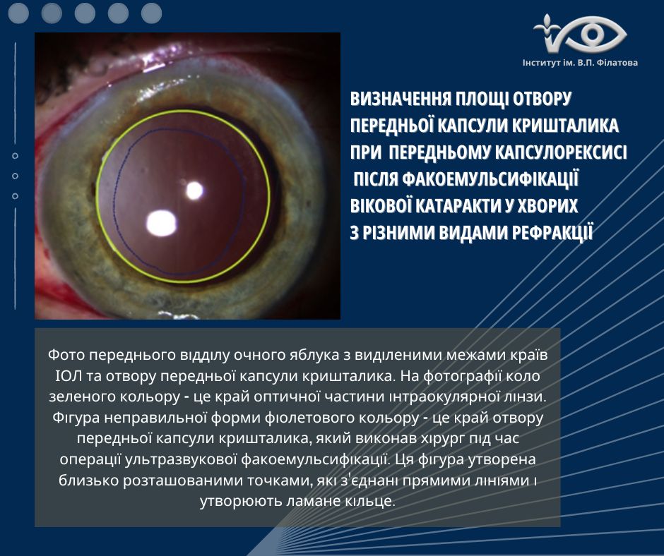 Визначення площі отвору передньої капсули кришталика при передньому капсулорексисі після факоемульсифікації вікової катаракти у хворих з різними видами рефракції