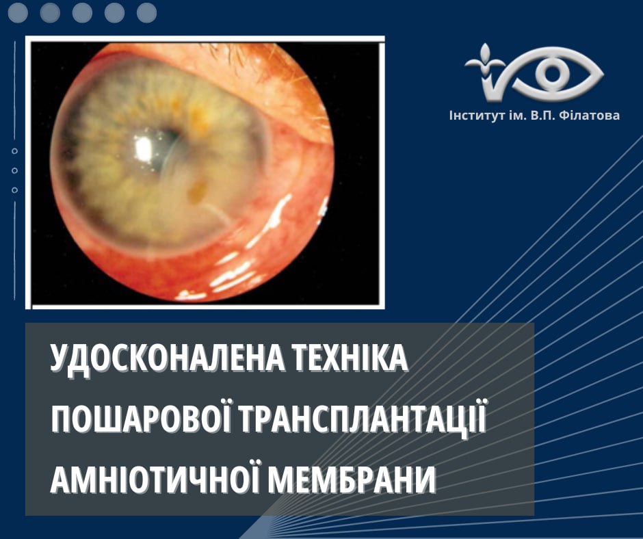 Удосконалена техніка пошарової трансплантації амніотичної мембрани