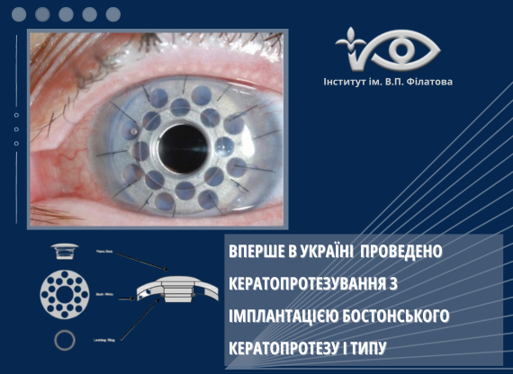 Вперше в Україні проведено кератопротезування з імплантацією бостонського кератопротезу І типу