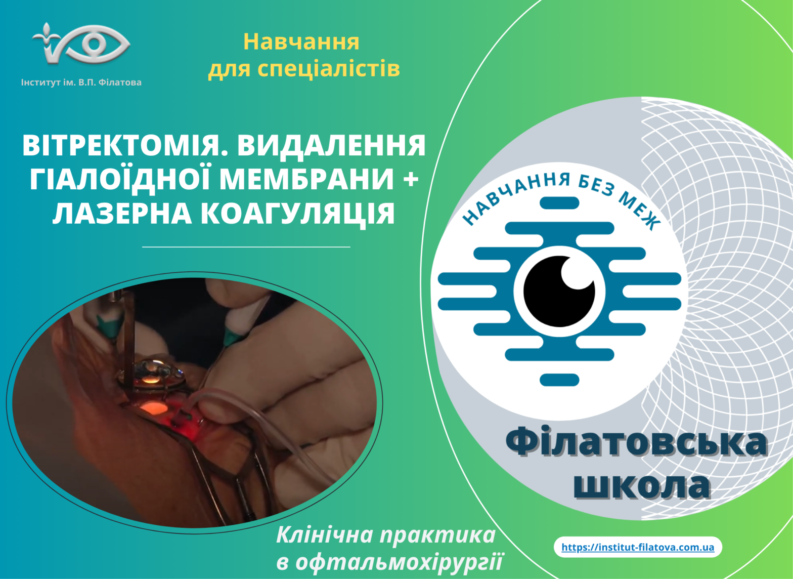 Запрошуємо вас на перегляд відео «Вітректомія. Видалення гіалоїдної мембрани + лазерна коагуляція».