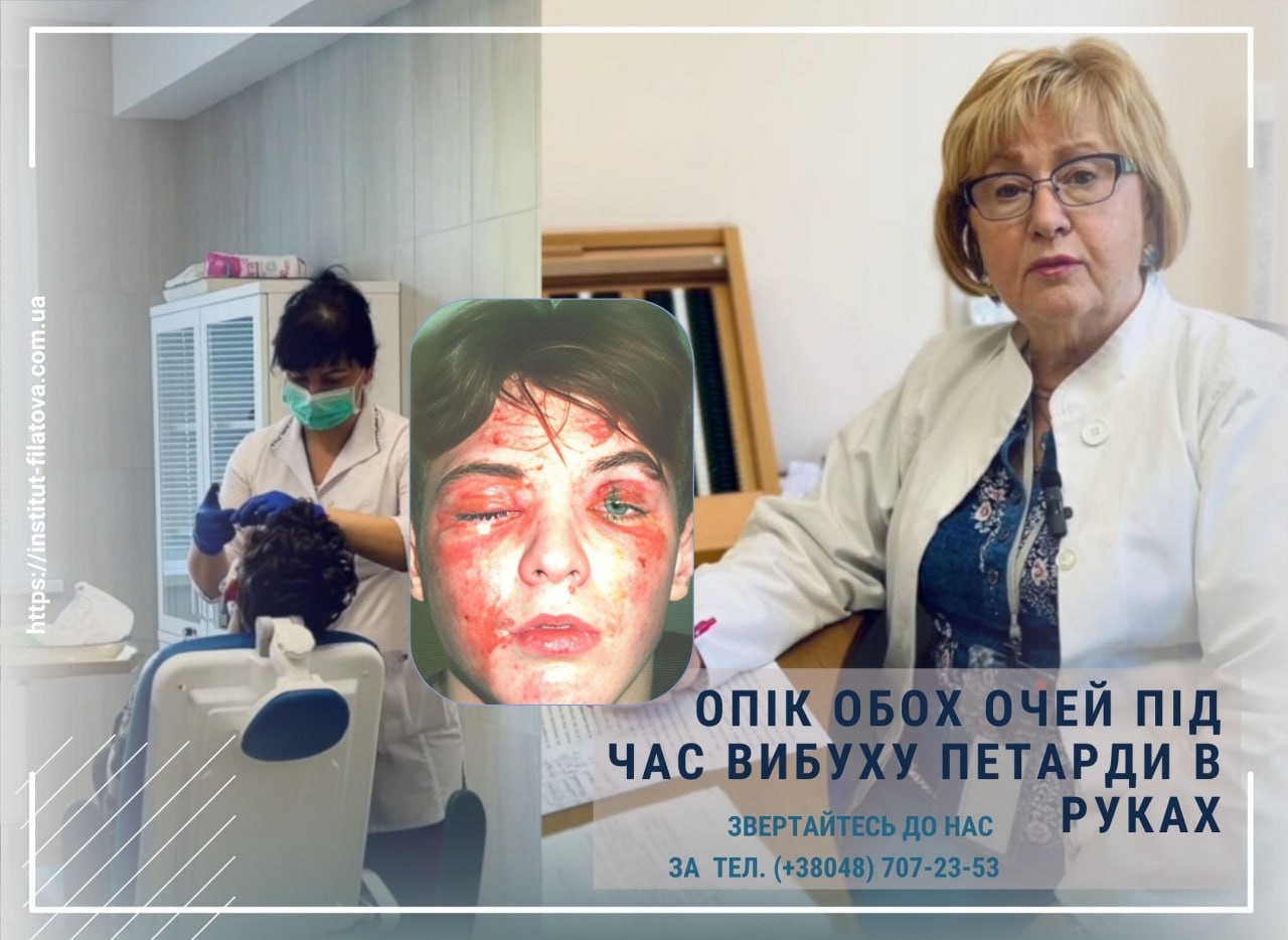 ОПІК ОБОХ ОЧЕЙ ПІД ЧАС ВИБУХУ ПЕТАРДИ В РУКАХ