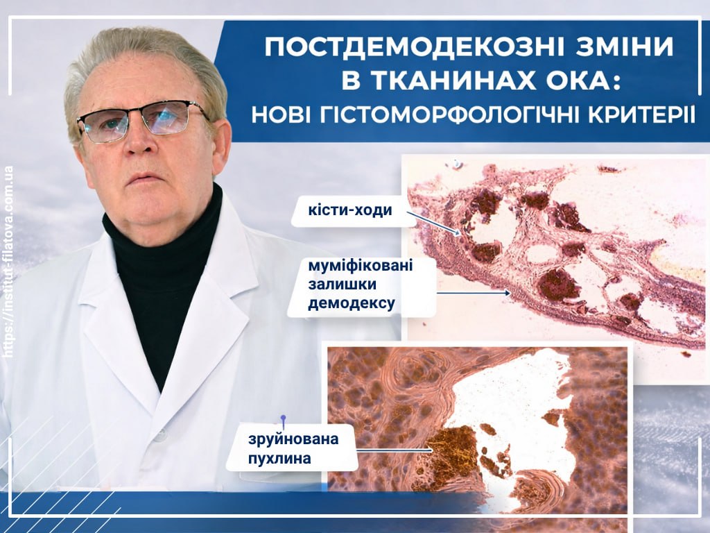 ПОСТДЕМОДЕКОЗНІ ЗМІНИ В ТКАНИНАХ ОКА: НОВІ ГІСТОМОРФОЛОГІЧНІ КРИТЕРІЇ